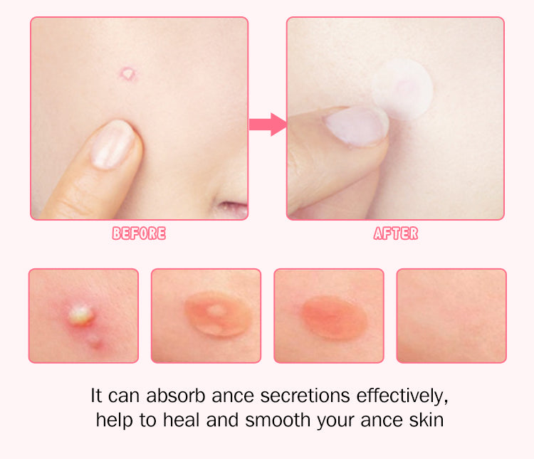Hemir Acne Pimple Patch