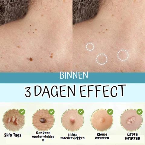 Skini™ - Moedervlekken & Wratten & Skin Tags verwijderaar